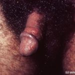 Scabies (Penis)