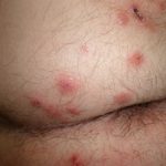 Nodular Scabies (Buttocks)