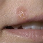 Oral Herpes