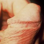 Pearly Penile Papules