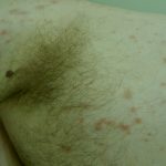 Scabies (Trunk)