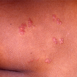 Herpes (Buttocks)