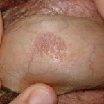 HPV (Penile Warts)