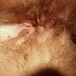 Perianal Vitiligo