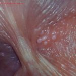 Parafrenular Glands (Tyson's Glands) 