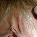 Sebaceous Glands (Fordyce Spots)