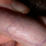 Penile Sebaceous Glands (Fordyce Spots)