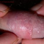 Sebaceous Glands (Fordyce Spots)