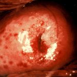 Trichtomoniasis (Cervix)